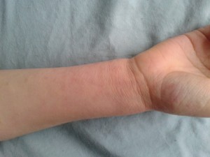 Wrist Jan 2015 after using Dr Aron cream